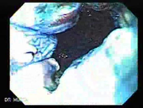 Barrett's Esophagus of long segment -state after Argon Plasma Coagulation (13 of 24)