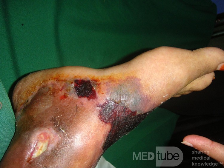 Diabetic foot - hemorrhagic bollus - tight bandage 