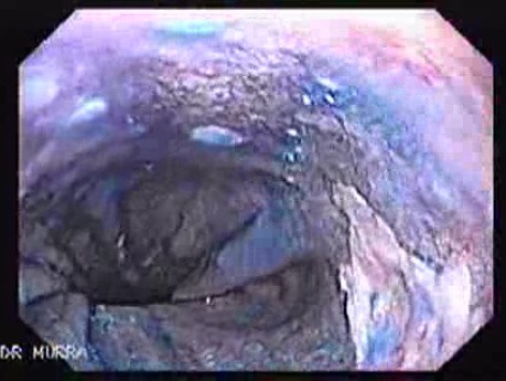 Barrett Esophagus - chromoendoscopy using methylene blue (6 of 6)
