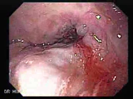 Upper Gastrointestinal Bleeding - Identification of the Site of Bleeding