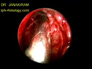 Type Iv Frontal Cell