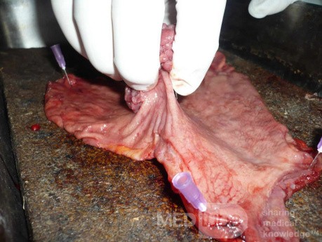 Polypoid Adenocarcinoma (5 of 9)