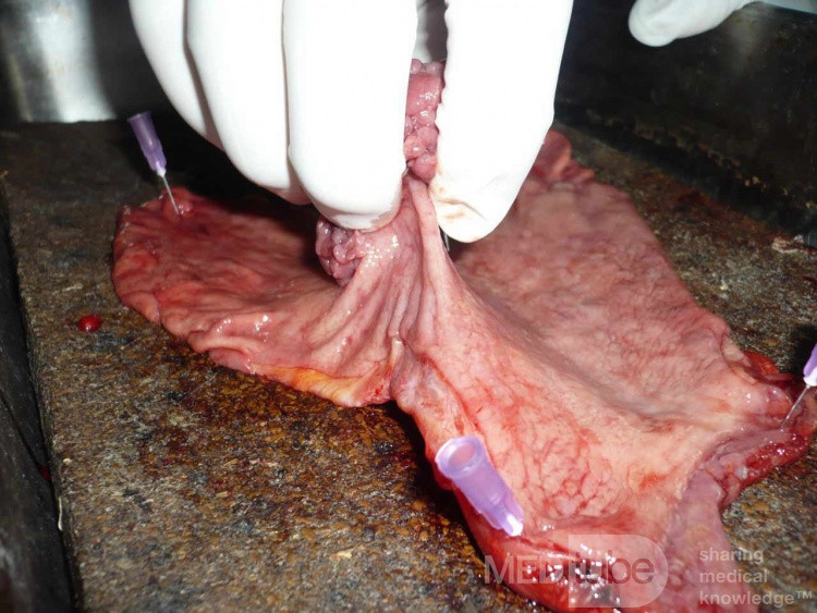 Polypoid Adenocarcinoma (5 of 9)