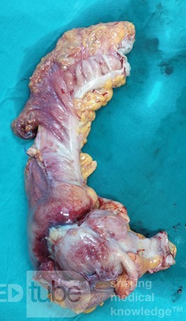 Right Hemicolectomy 