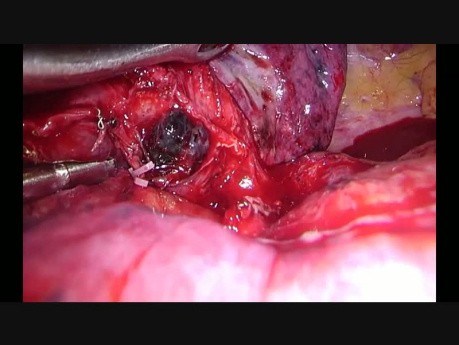 Use of 45º Applier for Polymer Clips through Uniportal VATS Lobectomy