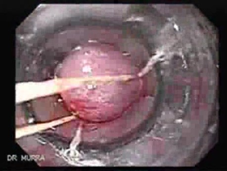 Severe Bleeding of the Upper Digestive System After Two Days of Band Ligation - Variceal Ligation, Part 2