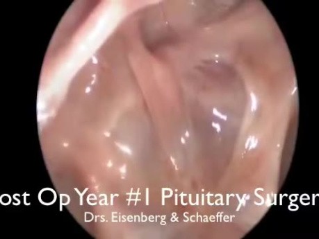 Follow up after Endoscopic Pituitary Surgery
