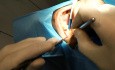Maxillary Implant Surgery