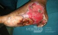 Diabetic foot - infected heel ulcer