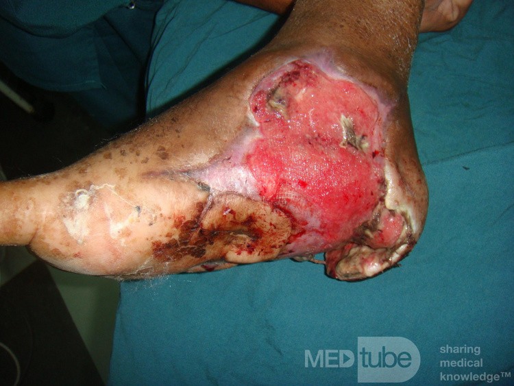 Diabetic foot - infected heel ulcer