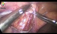 Overtightening Internal Ring in Congenital Hernia