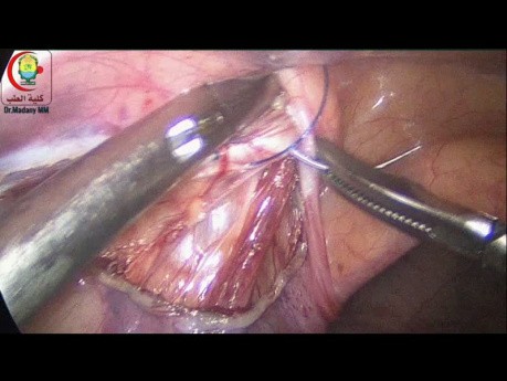 Overtightening Internal Ring in Congenital Hernia
