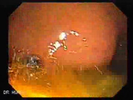 Invasive amebiasis and ameboma formation (2 of 4)