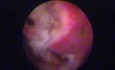 Large Endometrial Polyp in Menopause