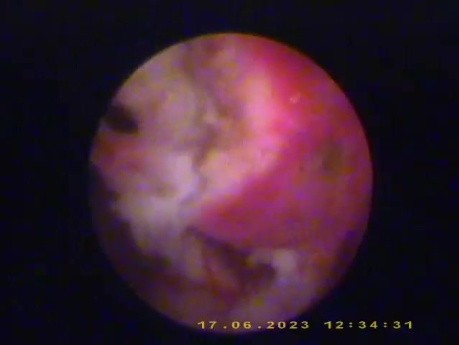 Large Endometrial Polyp in Menopause