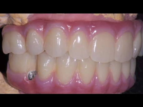 Several Teeth bimaxillary resolved with Toronto Bridges