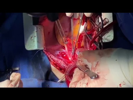 How to Perform Easily Pulmonary Endarterectomy with TCA Bilaterally