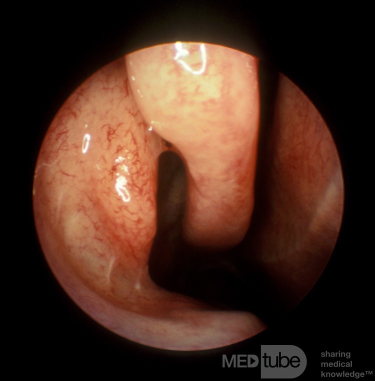 Medially Bent Uncinate Process