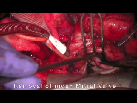 Redo Aortic and Mitral Valve Surgery with Gradual Adhesion Band Separation Technique 