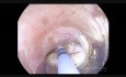 STER – Submucosal Tunneling Endoscopic Resection of SMT Localized in GE Junction