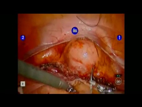 Uterosacral Suspension for Prolapse