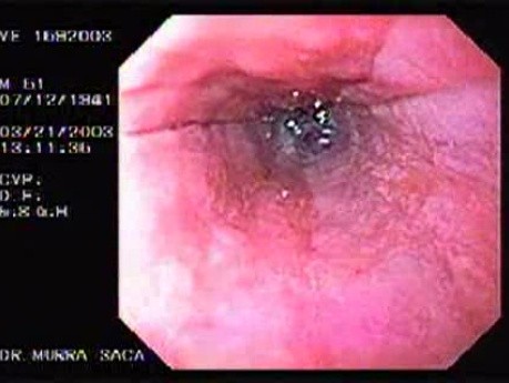 Banding of Esophageal Varices - Two Banded Varices