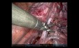 Anatomic Segmentectomy S7+8