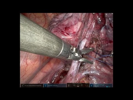 Anatomic Segmentectomy S7+8