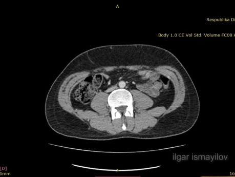 Laparoscopic Resection of Para-Aortic Mass