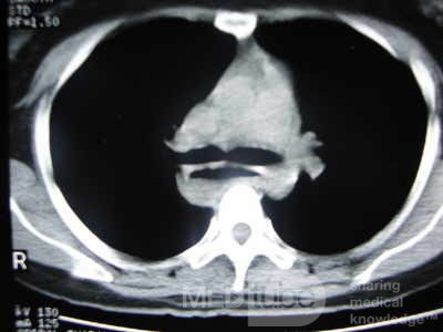 Esophagus - Pneumatic Dilation for Achalasia (26 of 31)