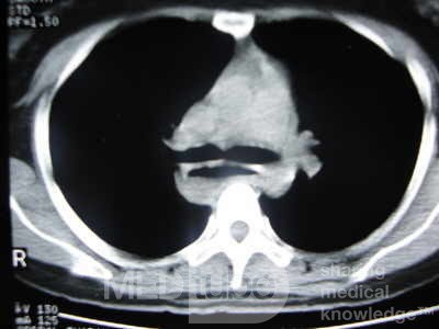 Esophagus - Pneumatic Dilation for Achalasia (26 of 31)