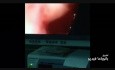Nasopharyngeal Cyst