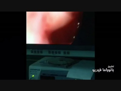Nasopharyngeal Cyst