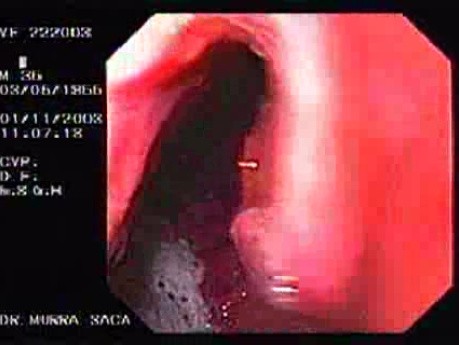 Ulceratice Adenocarcinoma of the Posterior Wall of the Gastric Corpus