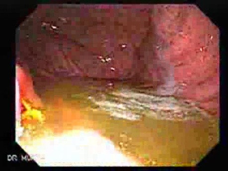 Acute Gastritis (1 of 6)