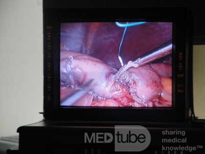 Gastric Ulcerated Adenocarcinoma of the Pre-pyloric Antrum (11 of 28)