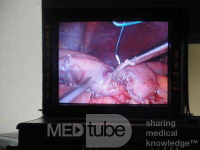 Gastric Ulcerated Adenocarcinoma of the Pre-pyloric Antrum (11 of 28)