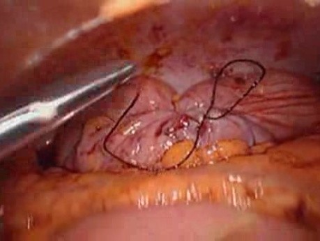 Colonic Perforation With Peritonitis - Laparoscopy (20 of 46)