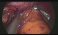 Sleeve gastrectomy