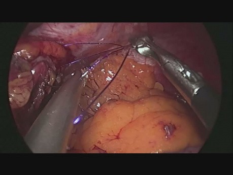 Sleeve gastrectomy
