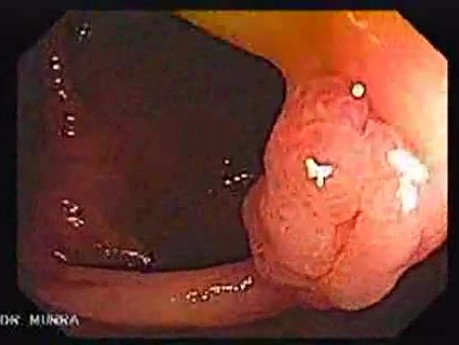 Sessile Tubulovillous Adenoma (1 of 13)