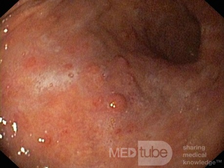 Unusual Appearance of Fundic Polyps. Chromoendoscopy. NET (2/6)