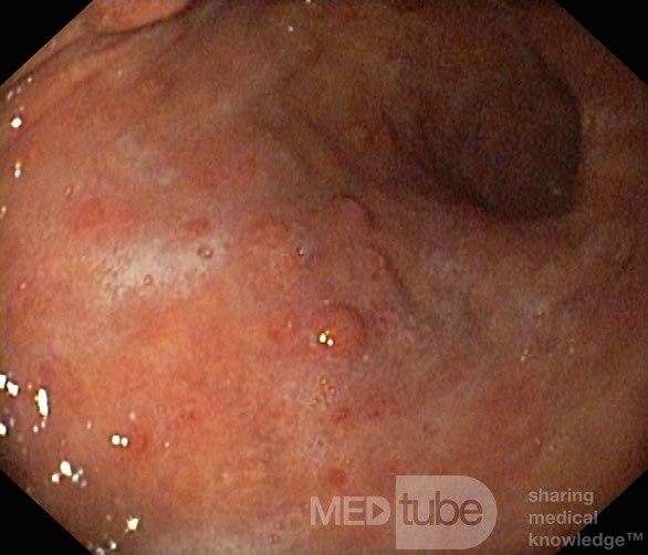 Unusual Appearance of Fundic Polyps. Chromoendoscopy. NET (2/6)