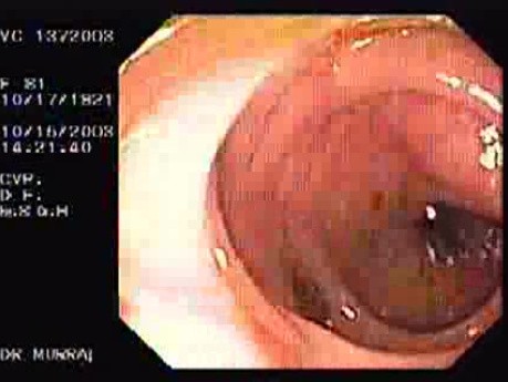 Tubulo - Villous Adenoma - Endoscopy (10 of 28)