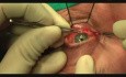Transconjuctival Approach, Mesh, Fracture, Orbit, Blow-out, Treatment, Maxillofacial Surgery