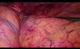 Laparoscopic Transperitoneal Left Adrenalectomy for NSCLC Metastasis - Full Length Video