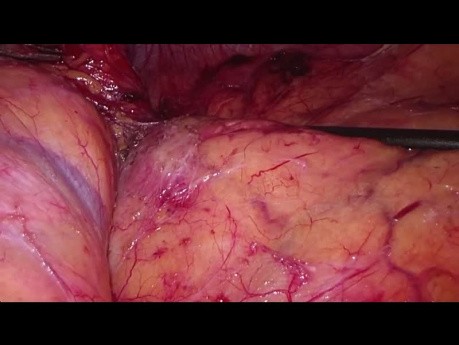Laparoscopic Transperitoneal Left Adrenalectomy for NSCLC Metastasis - Full Length Video