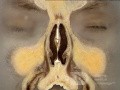 Coronal Anatomy of the Nose and Paranasal Sinuses: Slice 2