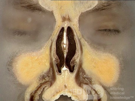 Coronal Anatomy of the Nose and Paranasal Sinuses: Slice 2
