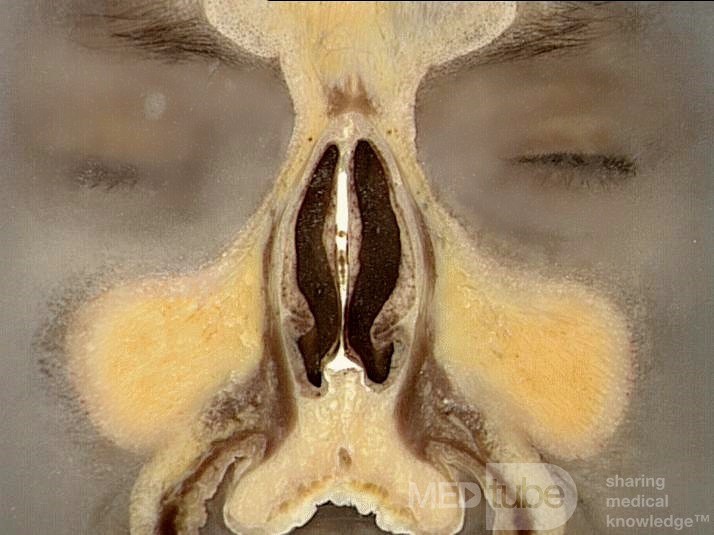 Coronal Anatomy of the Nose and Paranasal Sinuses: Slice 2